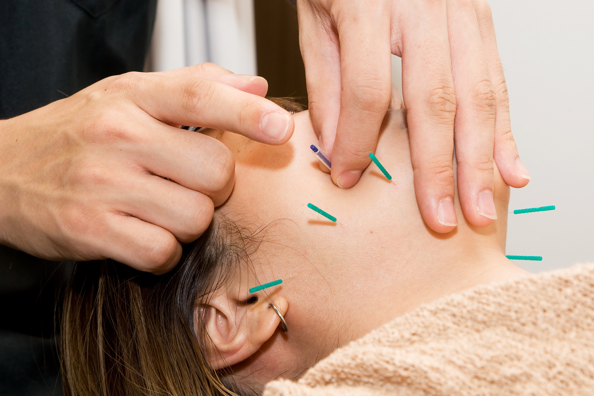 美容鍼