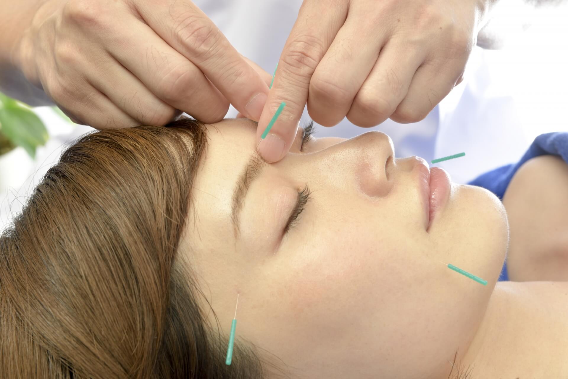 美容鍼